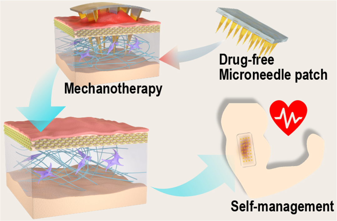 3D打印高精度微針模具助力微針物理治療增生性瘢痕的構效關系研究
